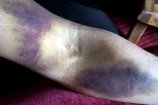 pay-thea-wilson-bruises-leukaemia