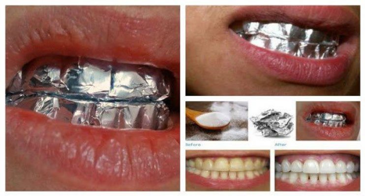 wrap-your-teeth-with-aluminum-foil-and-see-the-magic