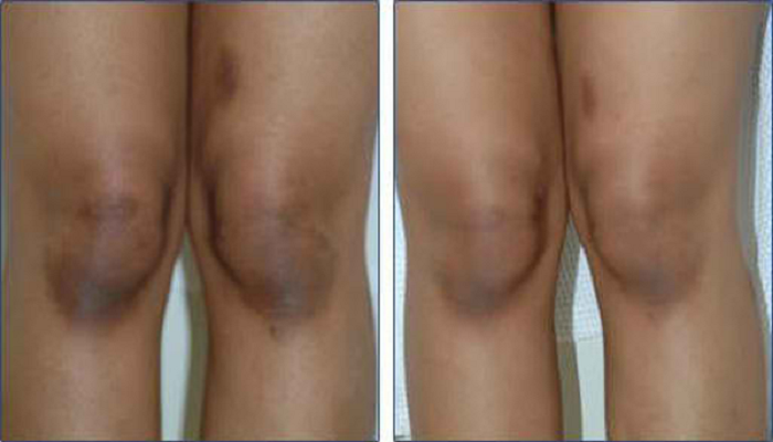 how-to-get-rid-of-black-knees-and-elbows