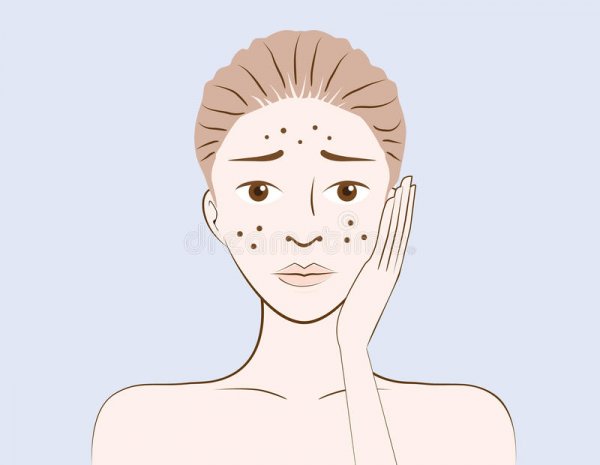 beauty-women-have-problem-acne-skin-face-cartoon-version-53914313