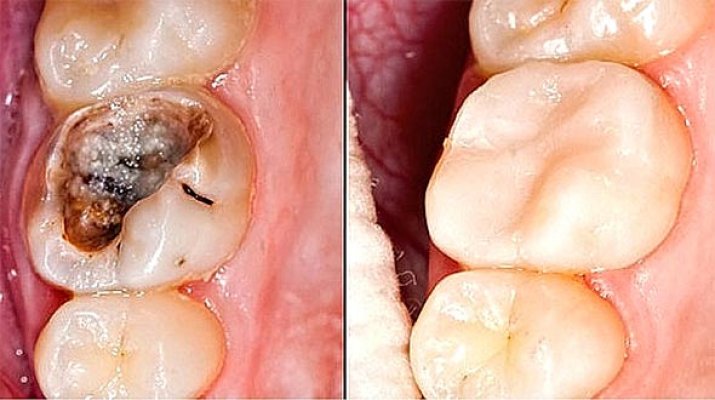 zubi-lijecenje