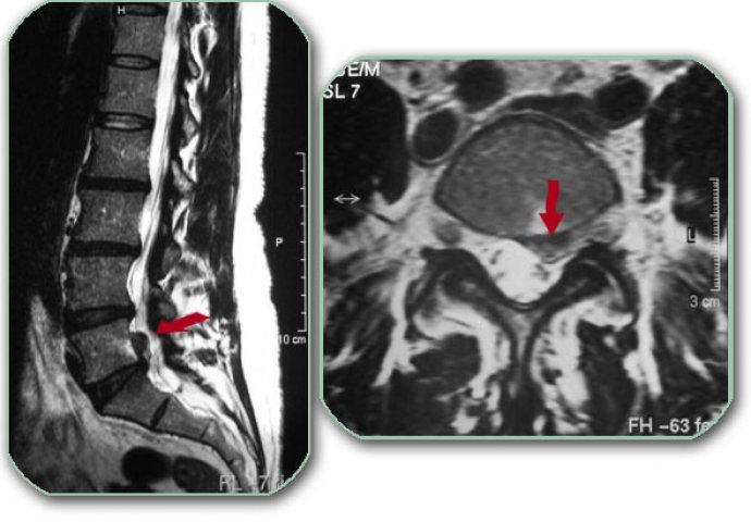 Diskopatija - bolest modernog doba