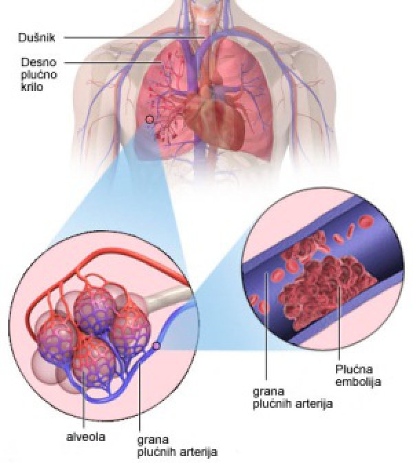 plucna-embolija