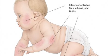 Dermatitis kod beba