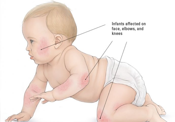 Dermatitis kod beba