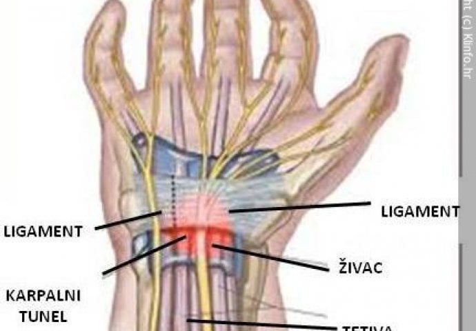 Sindrom karpalnog tunela