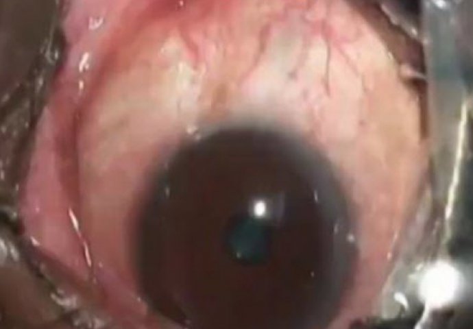 Operisali čovjeku oko: Ono šta su mu tamo našli šokiralo je i doktore