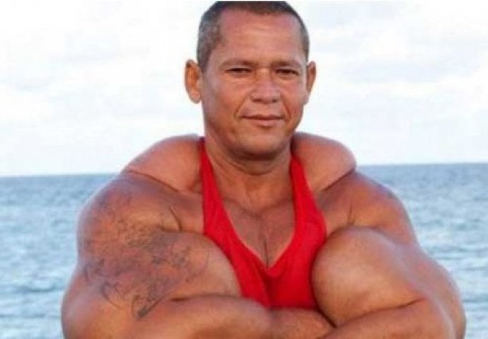 Sto ljudi, sto ćudi: Ubrizgava sintol u biceps kako bi imao najveće ruke na svijetu