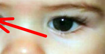 RODITELJSKA PAŽNJA: Ako ovo vidite u oku djeteta reagujte odmah jer bi moglo biti prekasno! 