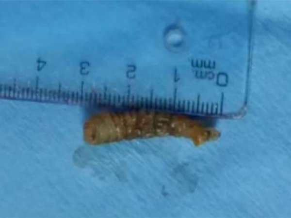 worm-in-eye