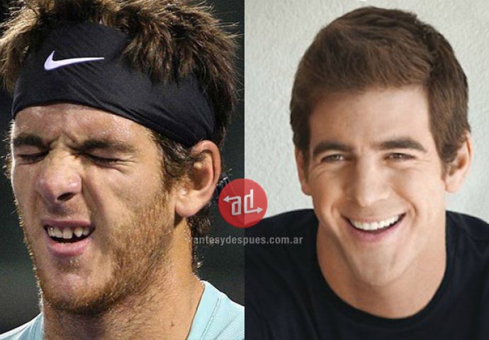 Priroda im nije podarila lijep osmijeh: Iznenadit ćete se kad vidite kako su slavne osobe nekada izgledale!