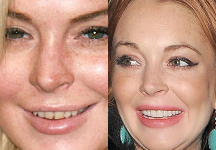 Priroda im nije podarila lijep osmijeh: Iznenadit ćete se kad vidite kako su slavne osobe nekada izgledale!