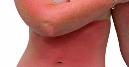 Ako ste zadobili opekotine prilikom sunčanja, ovo će vam pomoći