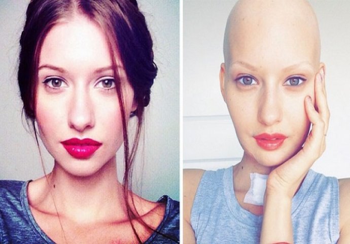 Priča jedne manekenke kojoj je bolest promijenila život!