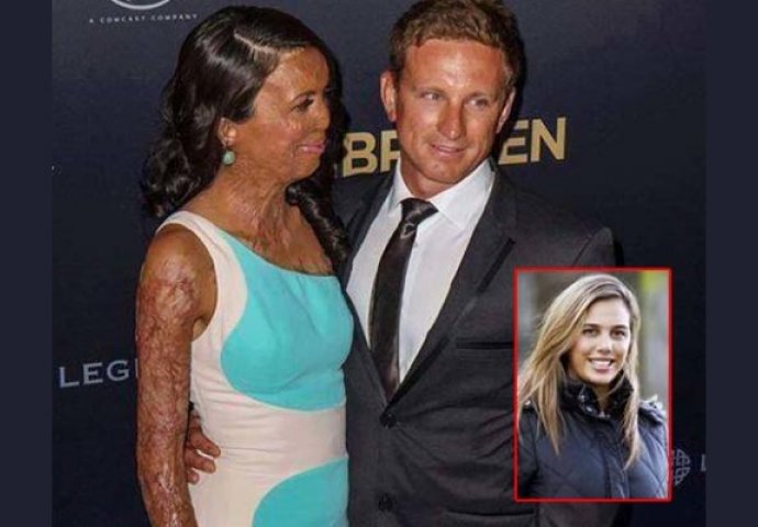 Bila je prelijepa manekenka dok joj tijelo nije izgorjelo u požaru! Njezin muž je cijeli svijet ostavio bez teksta!