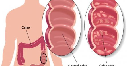 Ulcerozni kolitis kao "moderna" bolest debelog crijeva!