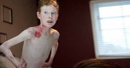 Ovaj dječak ima tragičnu sudbinu, njegova koža otpada na svaki najmanji dodir!