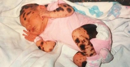 Na rođenju bila je prekrivena neobičnim mrljama, ali nećete vjerovati kako izgleda 19 godina kasnije