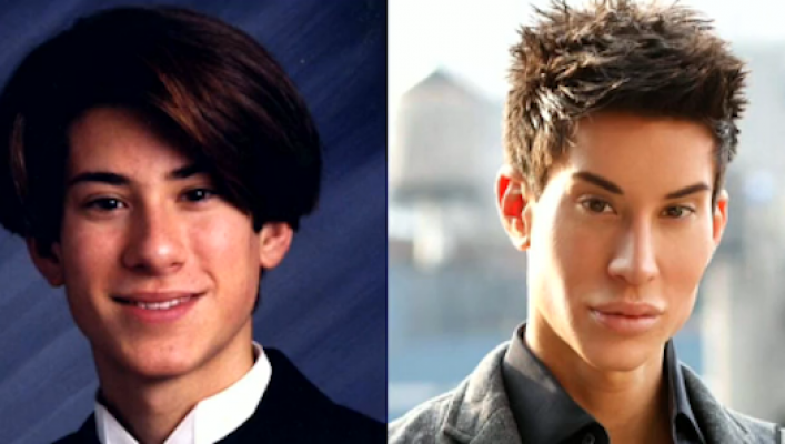 justin-jedlica-plastic-surgery-addict