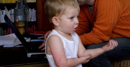 Sve više odraslih i djece bori se s ekcemima na koži, a ovo je 5 najčešćih zabluda