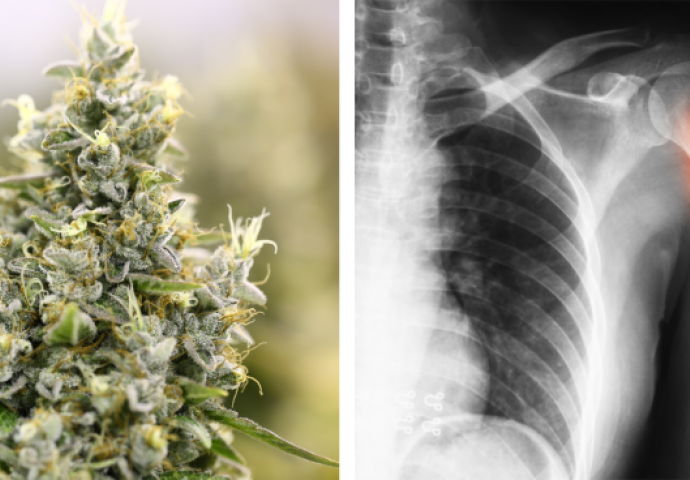 Marihuana bi mogla liječiti polomljene kosti