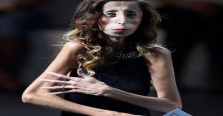 Oni žive sa sindromom "čovjeka kostura" i imaju nevjerovatne životne priče!