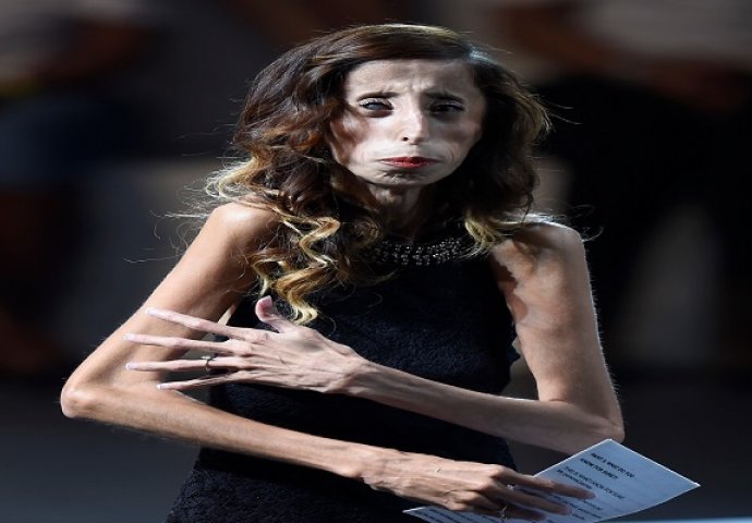 Oni žive sa sindromom "čovjeka kostura" i imaju nevjerovatne životne priče!