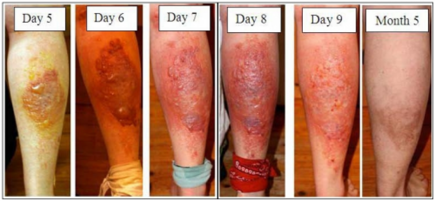 hogweed-sap-injuries-e1309990898846