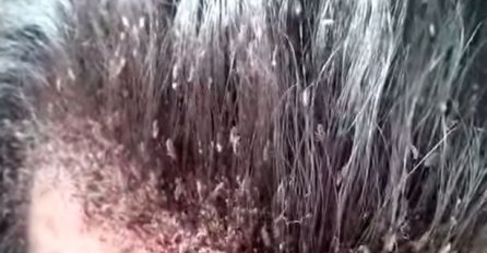 Zastrašujuće: Da li je ovo najgora najezda ušiju na kosi ikad?