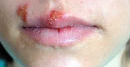 PRIRODNI LIJEKOVI: Ove namirnice su najbolji borci protiv herpesa
