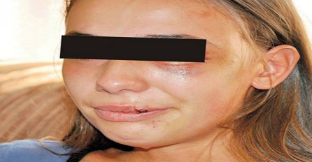 "Evo kako sam batine dobila od svog dečka, ne znam da li da ga prijavim policiji"