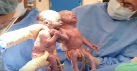 Kako danas izgledaju bliznakinje koje su se rodile držeći se za ruke (VIDEO)