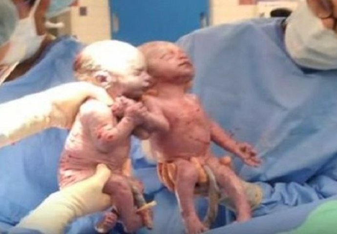Kako danas izgledaju bliznakinje koje su se rodile držeći se za ruke (VIDEO)