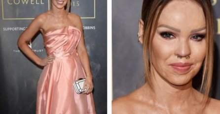 Udala se Britanka kojoj je bivši dečko kiselinom unakazio lice