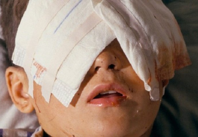 Dječaku raketa eksplodirala u lice,ljekari strahuju da će ostati bez oka!