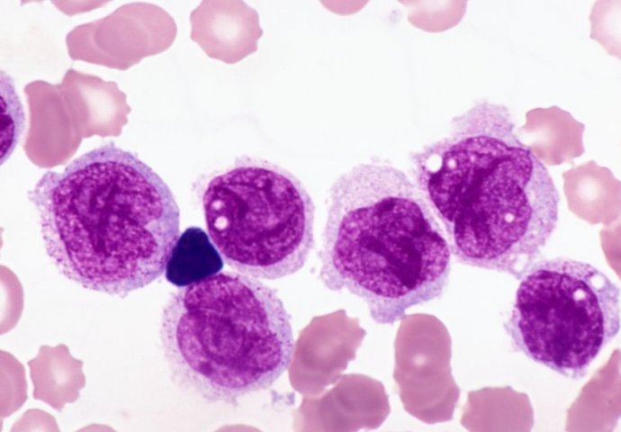 Akutna mijelocitna leukemija (AML)