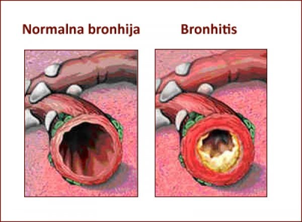 bronhitis