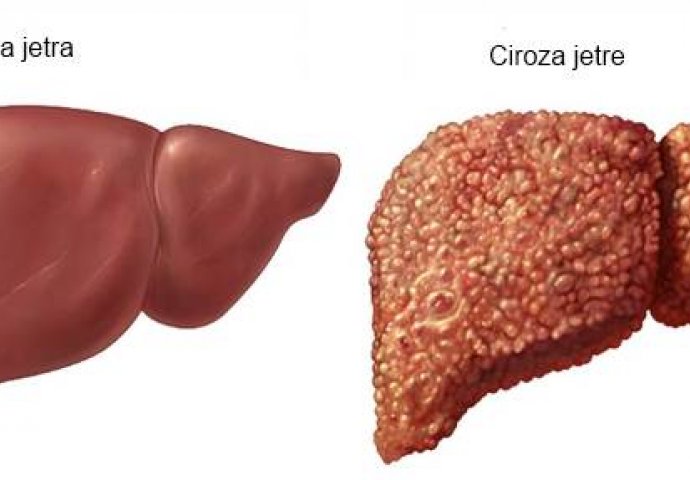 Masna jetra – uzroci, simptomi i liječenje | Bolesti - Kreni zdravo!