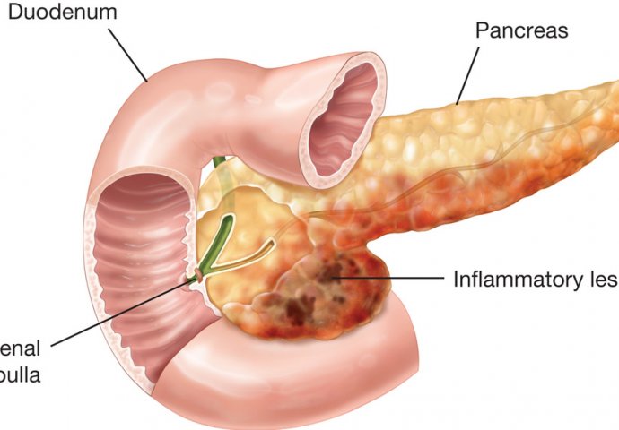 zajednički pankreatitis bol savjetovati za bol u ramenom zglobu