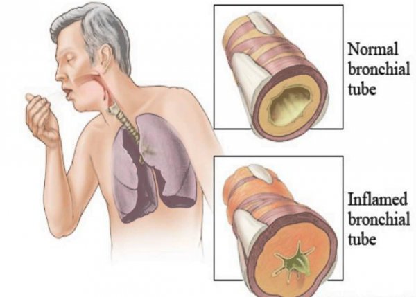 bronhitis