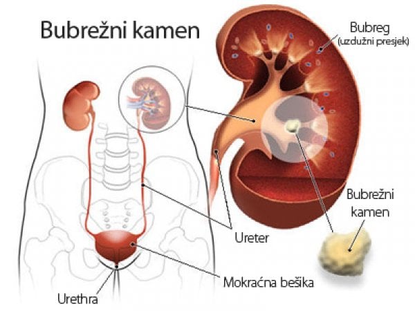 bubreg-kamenac