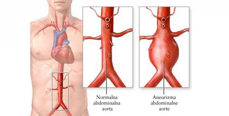 aneurizma-aorte1