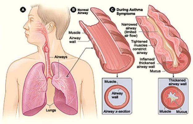 astma-2