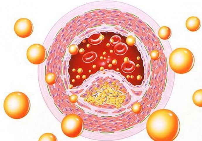 HIPERLIPIDEMIJA: Bolest koja nema simptome