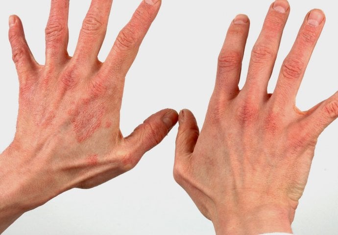 Atopijski dermatitis