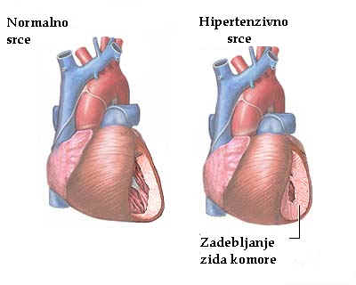 hipertenzija simptomi bubrega uzroci visokog tlaka