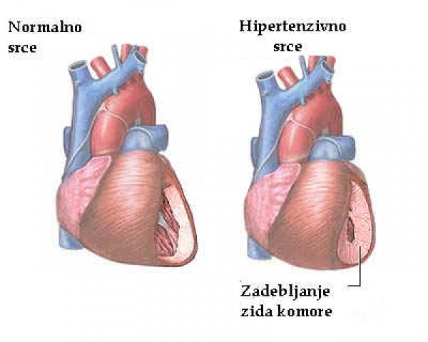 hipertenzija srca)