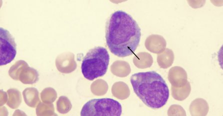 Hronična limfocitna leukemija (HLL)