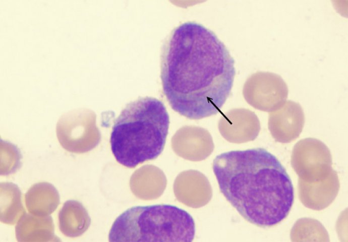Hronična limfocitna leukemija (HLL)