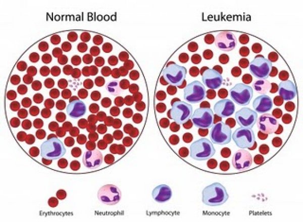 leukemija-2